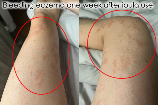 Bleeding eczema after treatment with ioula Body Lotion.