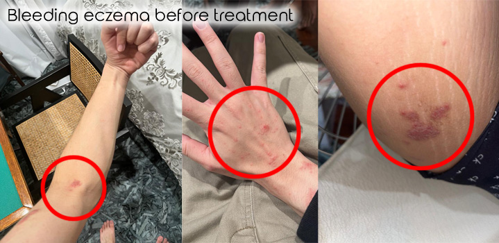 Bleeding eczema before treatment.