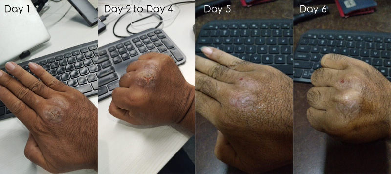 Flaky and cracked skin.