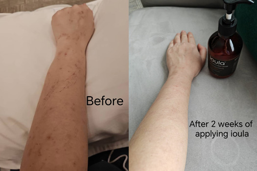 Post pregnancy rash on arms.