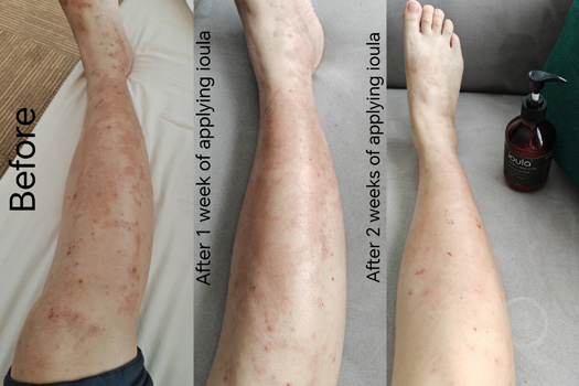 Post pregnancy rash on legs.