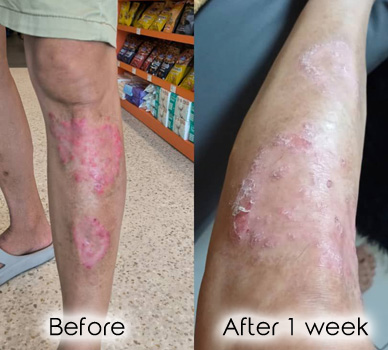 Psoriasis on legs.