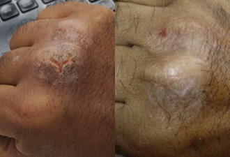 Overall skin dryness, flaking and cracking.