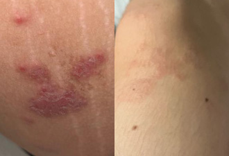 Full body eczema