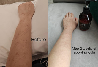 Post-pregnancy rashes