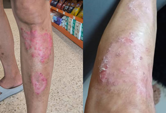 Psoriasis and prolonged steroid use